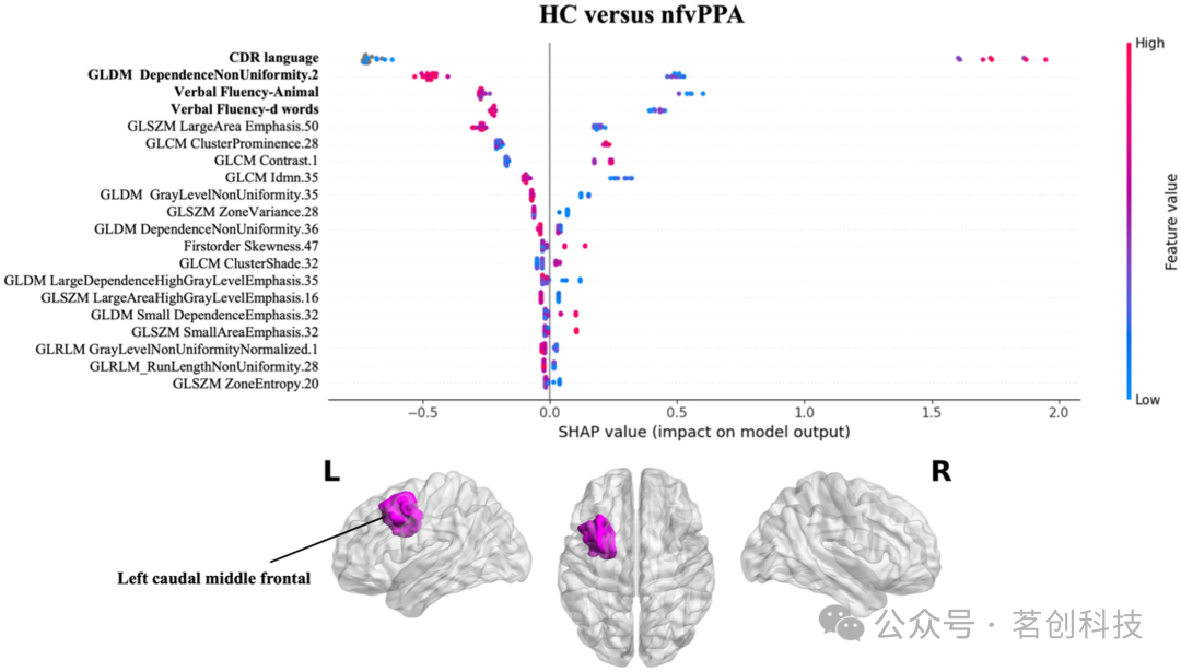 用于原发性进行性失语症分类的可解释性机器学习影像组学模型插图(5)