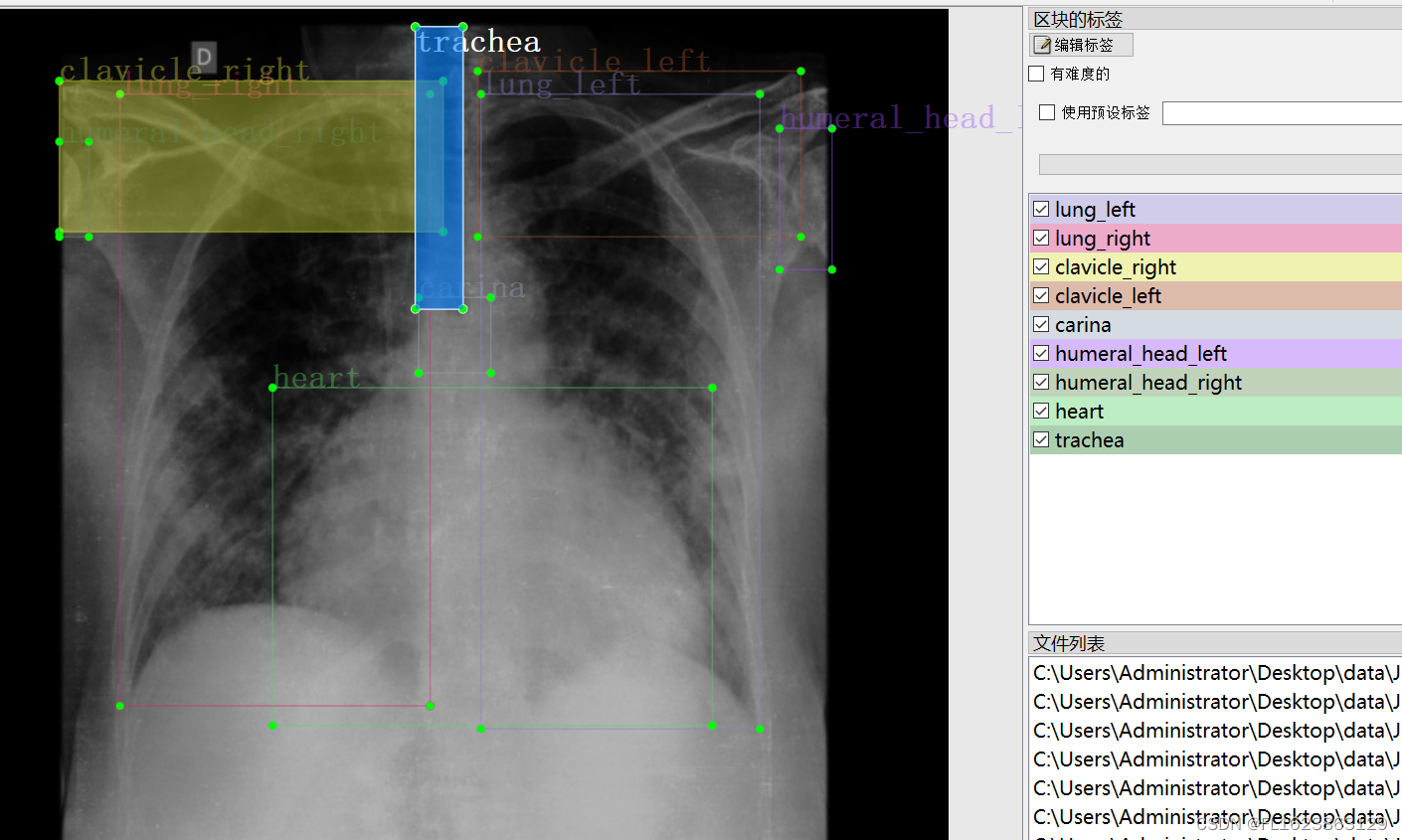 [数据集][目标检测]胸部解剖检测数据集VOC+YOLO格式100张10类别插图(1)